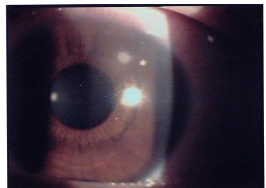 Ulcera corneale da lente a contatto